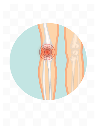 矢量元素关节疼痛概念元素膝盖