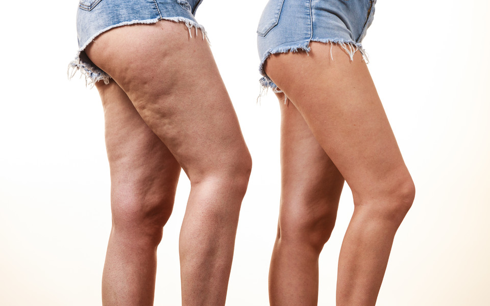 有和没有脂肪团的女性腿大腿的比较
