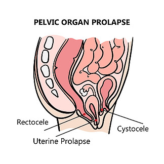 盆腔器官脱垂医学教育计划向量集