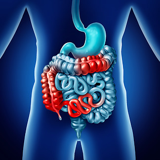 克罗恩病和<i>肠</i>道疾病或克罗恩病医学概念作为人类消化结<i>肠</i>与炎症症状导致阻塞作为 3D 插图。