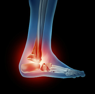 脚踝足部疼痛，行走身体部位的骨骼呈红色，骨骼为红色，侧视关节<i>发</i><i>炎</i>，因鞋子不好或跑步事故导致骨科关节损伤。