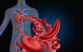 镰状细胞心血管心脏血液循环和贫血作为人体动脉解剖中正常和异常血红蛋白的疾病，作为具有 3D 插图元素的医学插图概念。