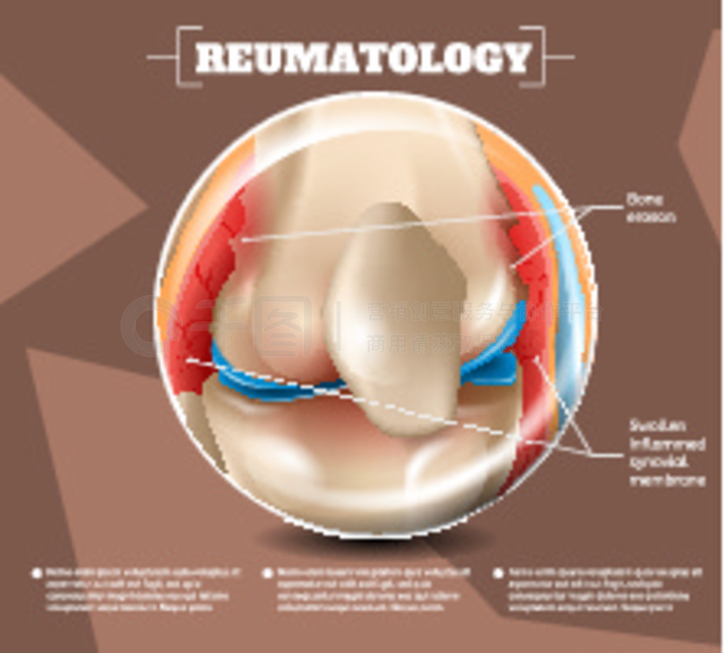 ʵ֤ Reumatology ҽѧ 3dʸͼҽѧṹ˺ͼʴͷ׵ĻĤϥؽ