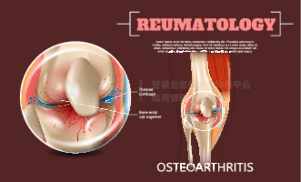 ǹؽϥؽڵʵ֤ 3d ʸͼ Reumatology ϥؽڡǱ䱡Ƕ໥Ħоṹȹؽ