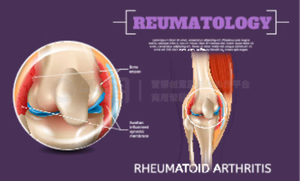 ʵ֤ϥؽʪؽס 3d ʸͼ Reumatology ϥؽڡҽƿӻϥؽˡоṹȹؽ