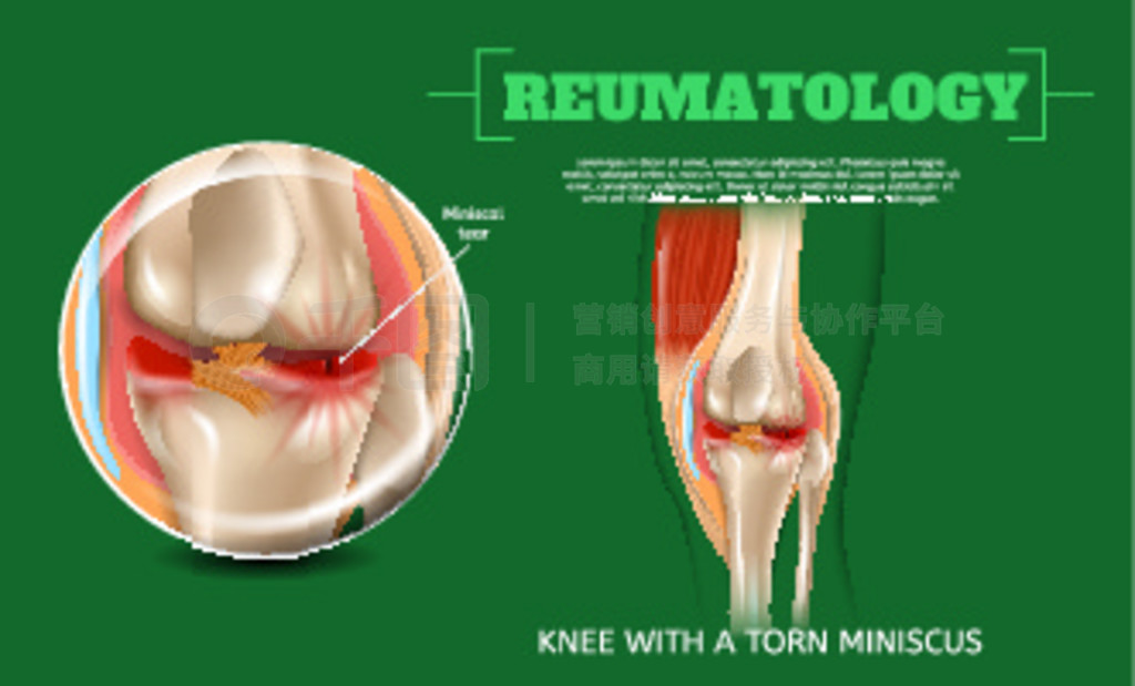  3d ͼϥ˺ѵ Miniscusʸͼ Reumatology ϥؽڡҽѧӻϥؽˣ°˺ѡŤʹȹؽڡ