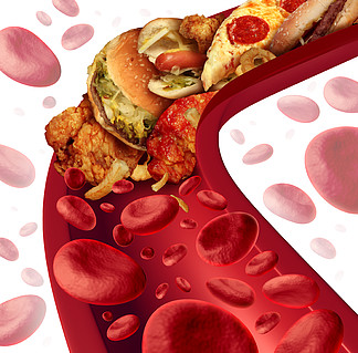 胆固醇阻塞动脉医学概念与人体血管被不健康的食物（如汉堡包和油炸食品）堵塞作为节食和营养问题如吃脂肪的健康风<i>险</i>隐喻。