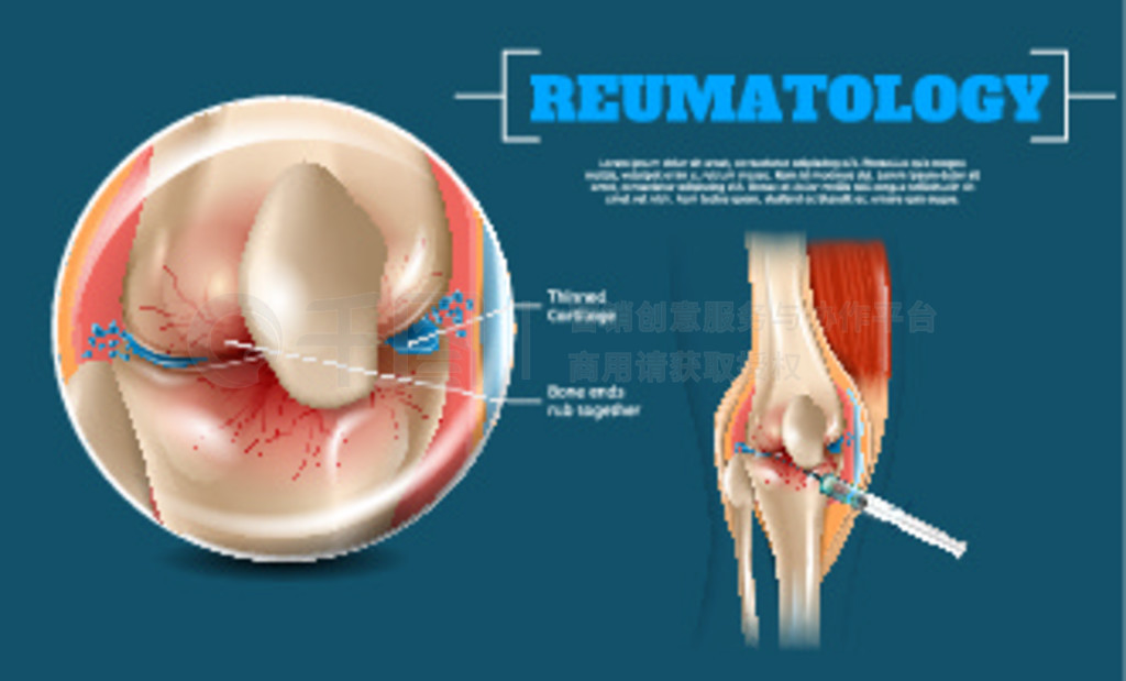 ͼȷע䲿λ 3d  Reumatology ϥǡעҺĦƹǵϥؽںע䲿λдͼ