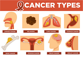 <i>癌</i><i>症</i>类型海报与各种疾病载体。Larine 和肺、胃和骨、卵巢和脑、乳腺<i>癌</i>和黑色素瘤。恶性细胞结肠集中在一个区域的严重疾病。带有各种疾病载体的<i>癌</i><i>症</i>类型海报