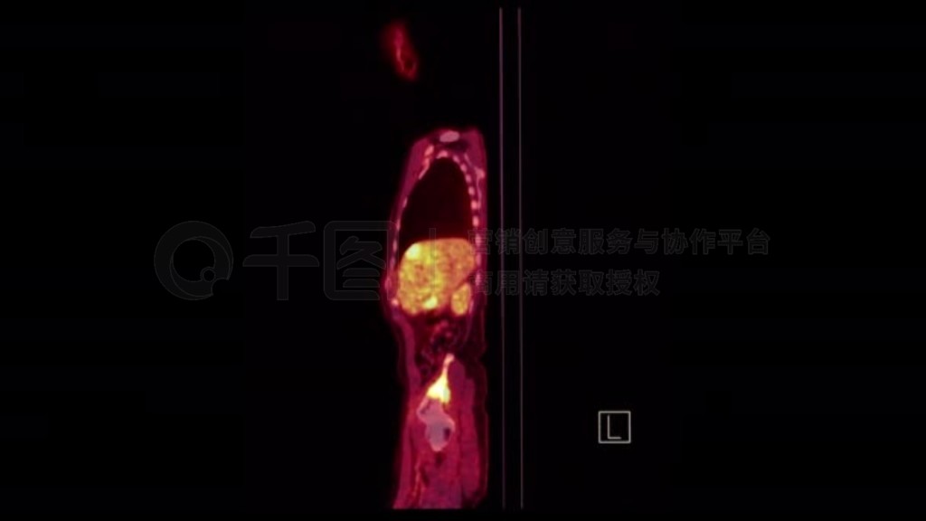 ȫ3Dɫʸ״ͼPET CT (ӷ).