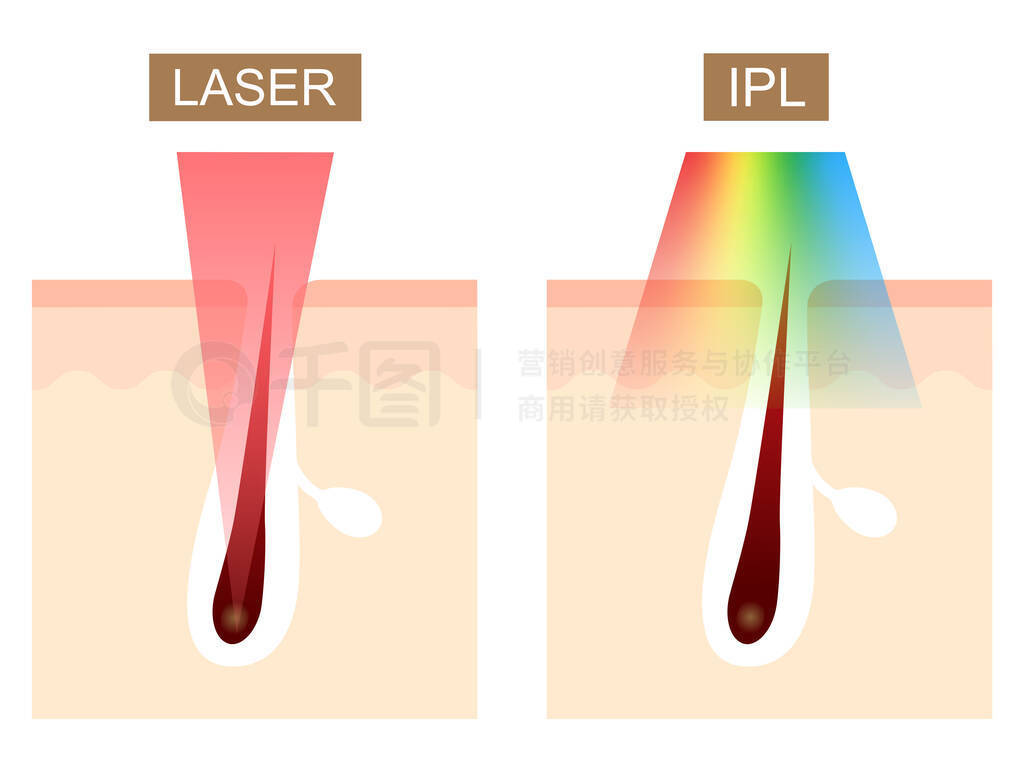 IPL(ǿ)ë.