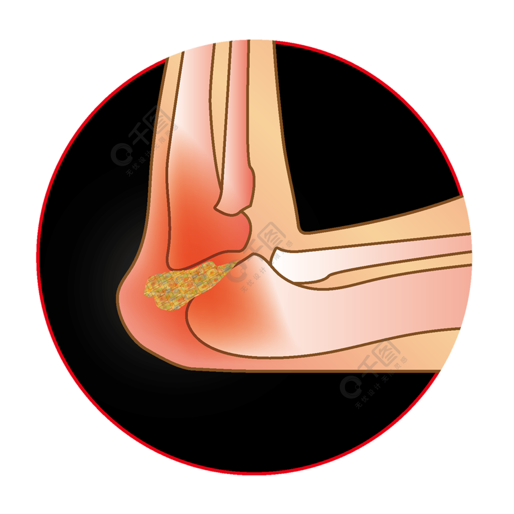 手绘肘部痛风示意图