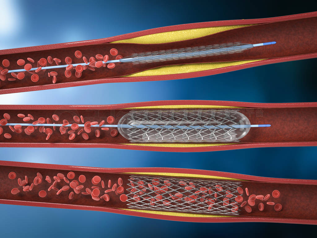 Balloon angioplasty procedure