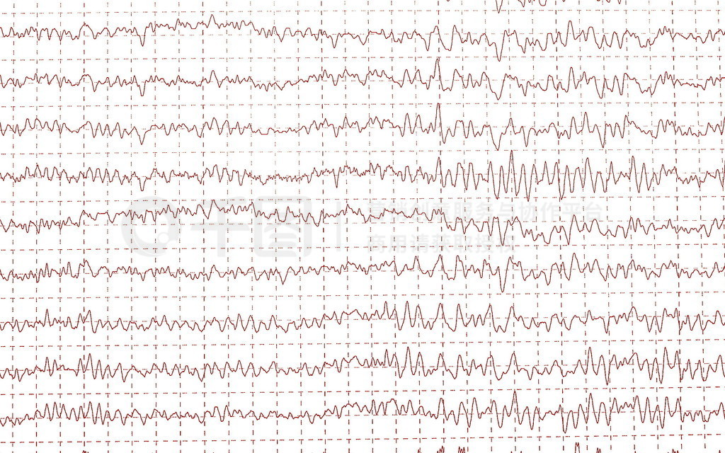 Ե粨Եͼ(EEG)