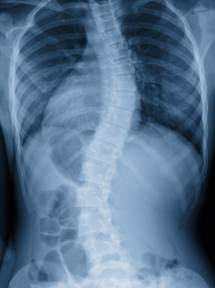 脊柱侧凸 x 光胶片在青少年病人中显示骨架折弯