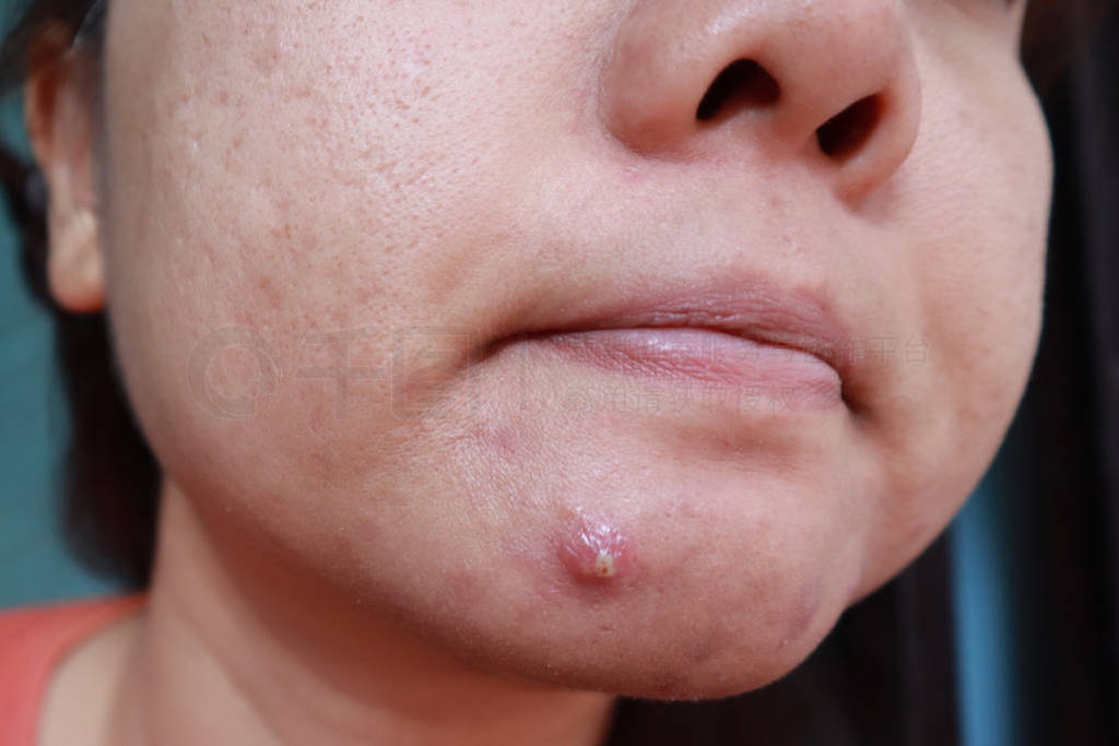 Woman squeezing pimple with dirty bare hands, Removing pustules
