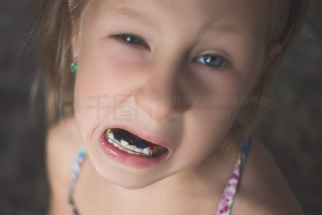 A little girl with crooked teeth shows an orthodontic appliance