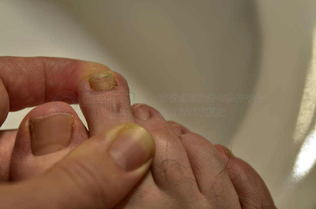 Close-up image of a fingernail on the right foot of a Caucasian
