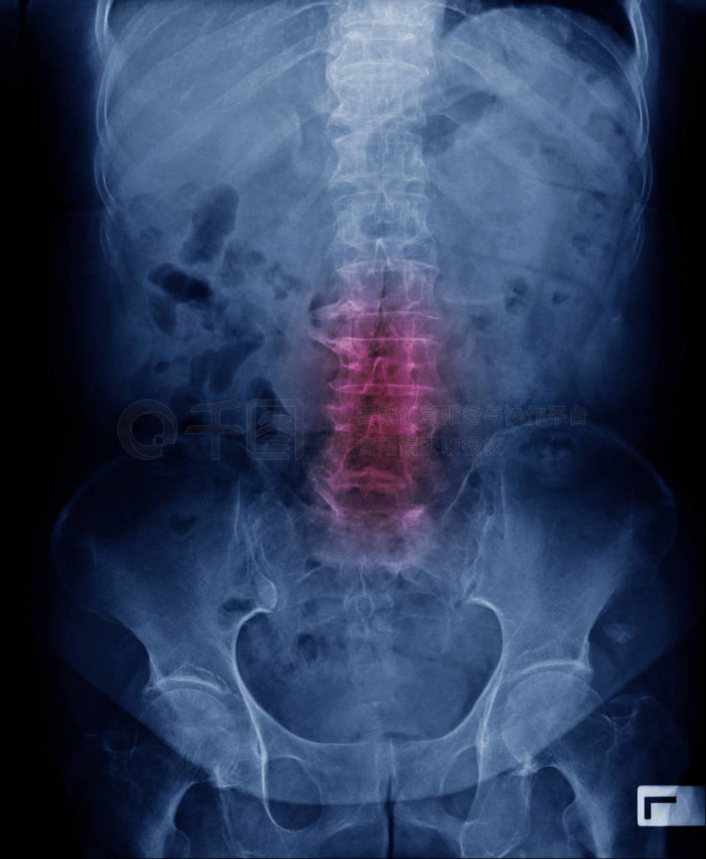 old man x-ray, lumbar x-ray image with pelvic bone
