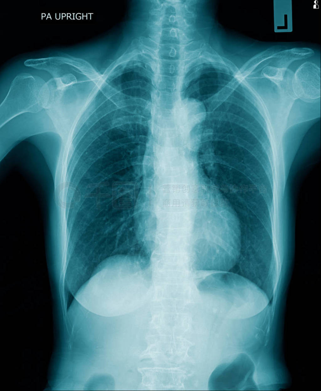 human chest x-ray