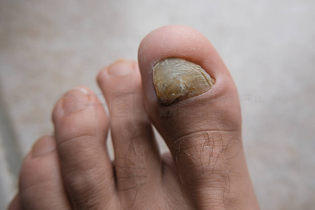 Man finger sick onycho mycosis nails closeup,dermatologic health