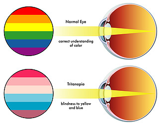 藍盲,第三色盲 第三原色盲 黃藍色盲