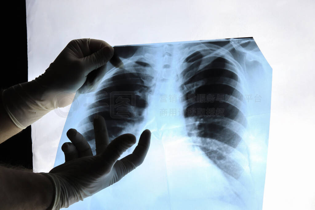 Hands of a doctor and an x-ray of the lungs, chest of a patient