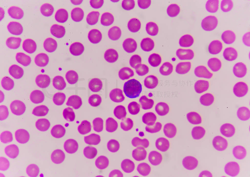 Normochromic normacytic Ѫϸ