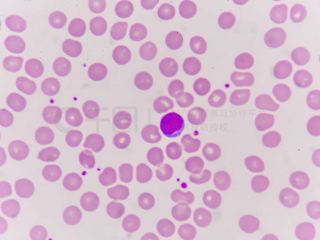 Normochromic normacytic Ѫϸ