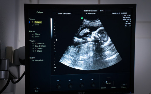 产科超声检查的胎儿