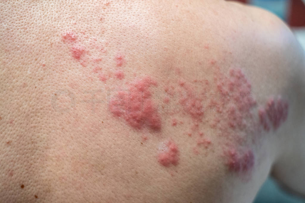 Shingles (Disease), Herpes zoster, varicella-zoster virus. skin