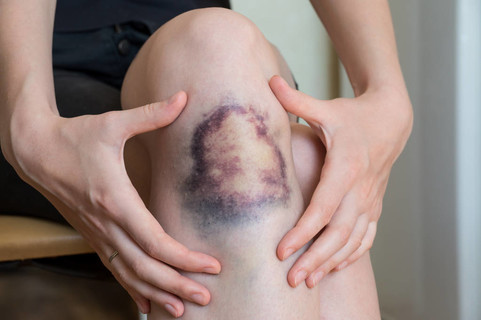 女生膝盖淤青是老司机图片