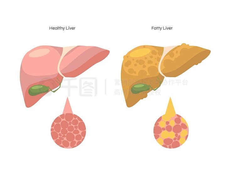 脂肪肝手绘图图片