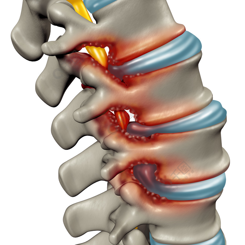 作为在导致压缩的脊椎神经医疗概念的人的椎骨的退行性疾病作为3d例证