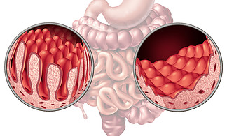 与正常绒毛和损坏的小肠衬<i>里</i>的腹腔或腹腔肠道疾病解剖医疗概念作为消化系统的自身免疫失调与结肠和胃的作为3D例证