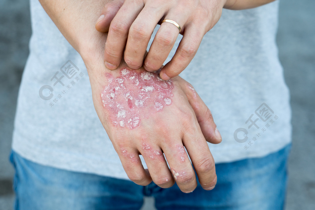 男人手上抓自己片状皮肤干燥与寻常型银屑病湿疹和其他皮肤状况如真菌