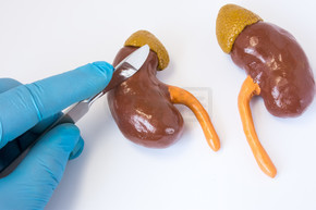 肾脏手术概念照片。3d 解剖形状的肾脏与肾上腺外科医生旁边手在蓝色的手套，拿着手术刀。在癌症、 肾积水、 石头、 移植肾手术