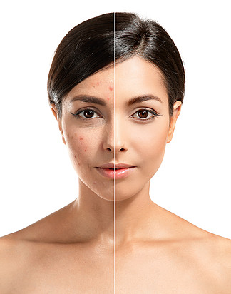 女性面部痤疮治疗前后的程序。护肤理念.