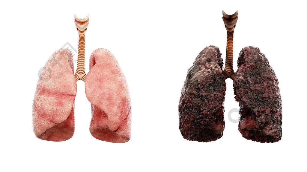 健康的肺和病肺白色隔离尸体解剖医学概念癌症和吸烟问题