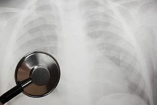 <i>Medical</i> stethoscope and x-ray or roentgen image. Close-up shot of lung radiography