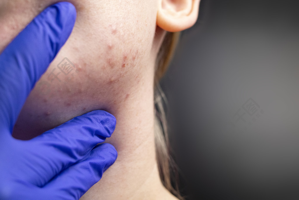 下巴上的痤疮：脱落感在女孩脸上的皮肤上打勾。 一位皮肤科医生的预约病人。 皮肤与美的概念.