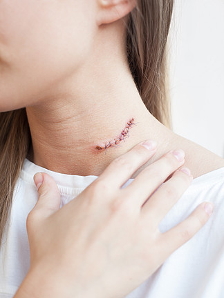 女人的脖子上的<i>刀</i>疤鼹鼠