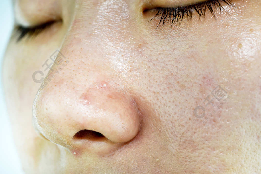 皮肤问题与痤疮病, 关闭女性脸上的白石丘疹的鼻子, 疤痕和油性油腻的脸, 美容概念.