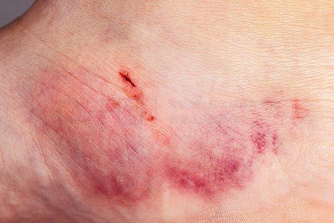 一名受伤妇女腿部皮肤瘀伤的特写